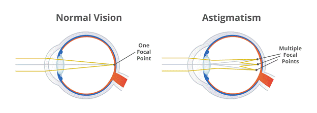 what is a astigmatism in the eye